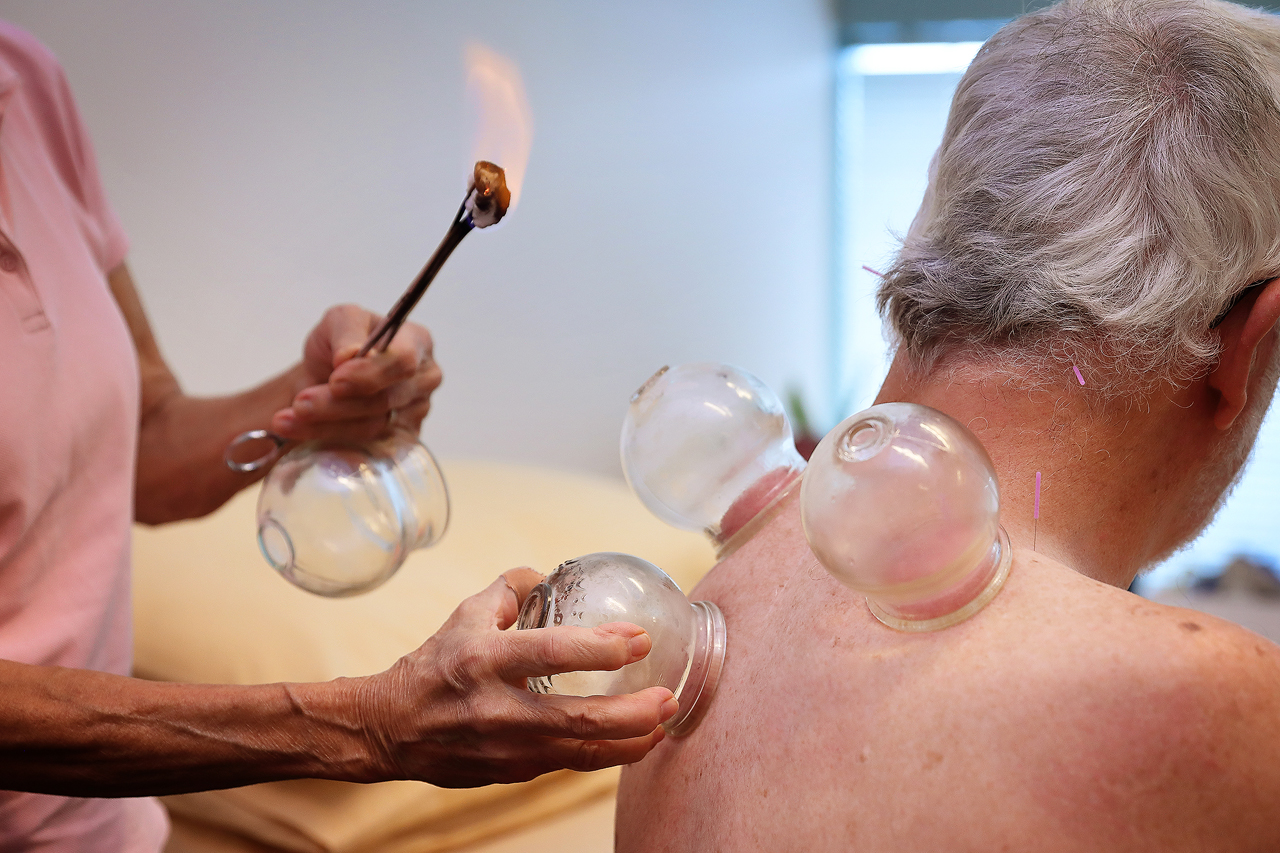 acupuncture, cupping and dry needling in norwest