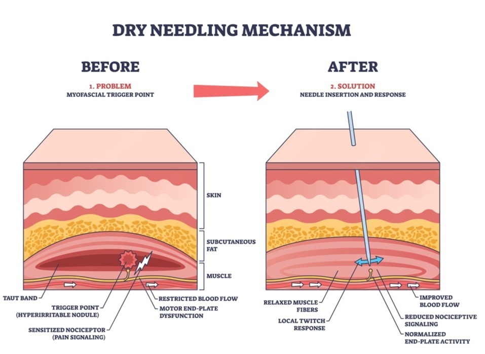 What Is Dry Needling?
